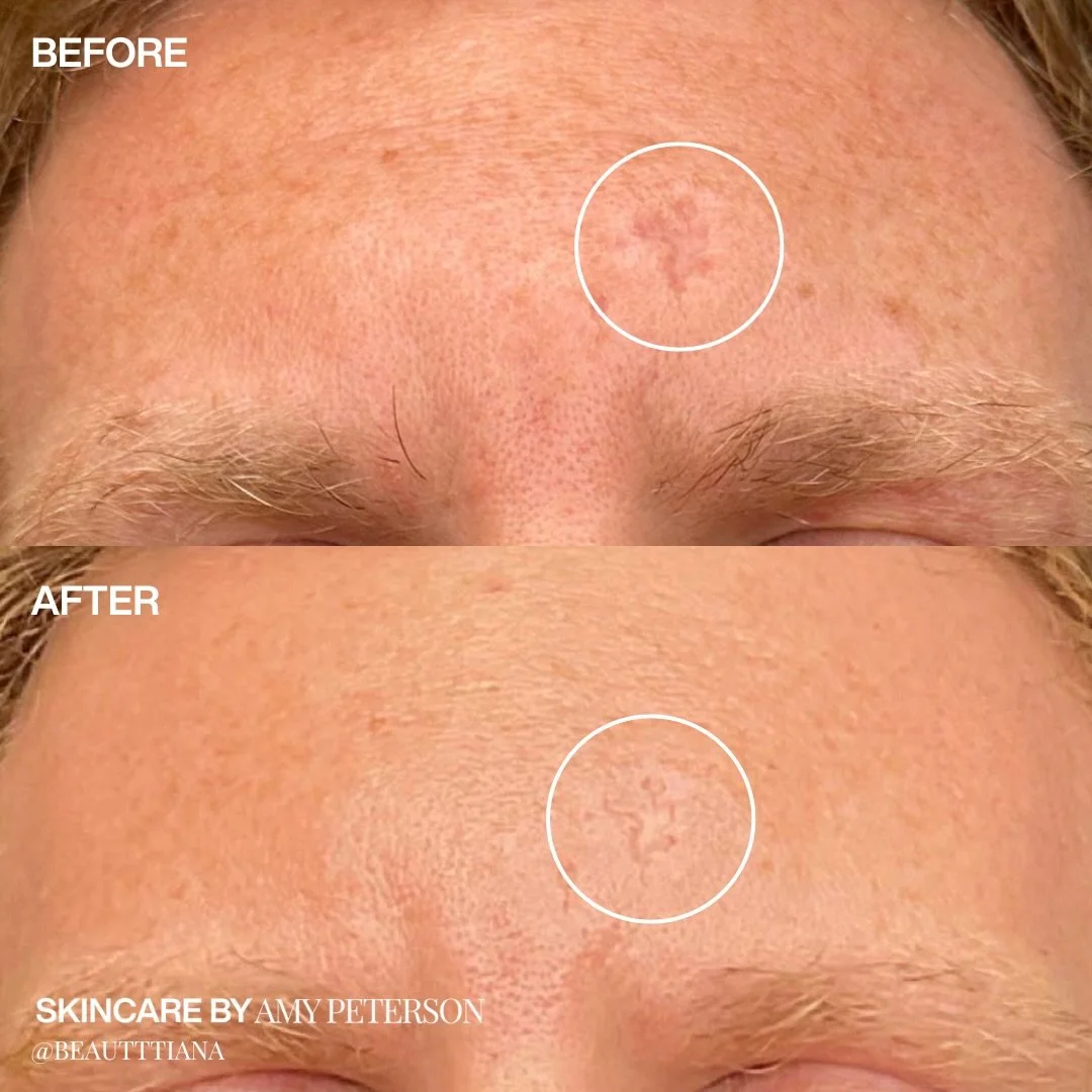 Some of our favorite laser moments from this year 🤍

Real skin. Real progress. Subtle changes that add up over time. These transformations are the result of thoughtful plans, advanced technology, and taking the time to do things the right way.