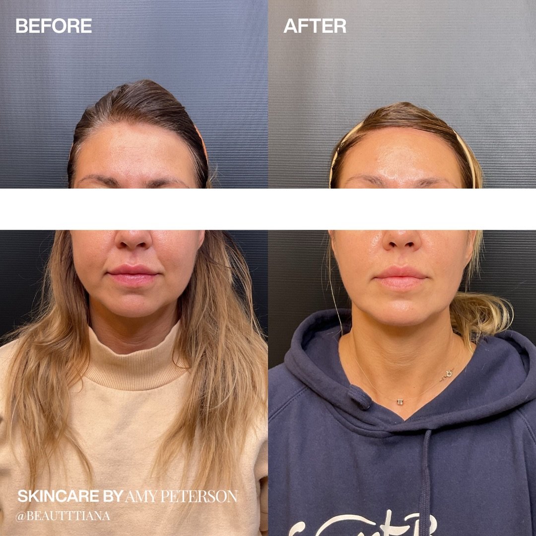 This transformation combines two treatments that work beneath the surface.

Endolift helps tighten and refine the tissue, while Renuva supports the body&rsquo;s own ability to restore soft volume over time.

The result is subtle, balanced, and design