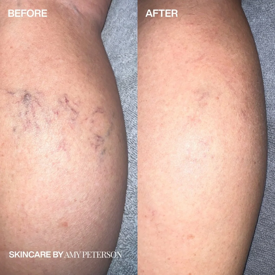 Sclerotherapy is a cosmetic treatment that helps improve the look of the legs, with results that continue to refine over the weeks following treatment. It treats visible spider veins at the source.

Call or click the link in bio to book your consult 