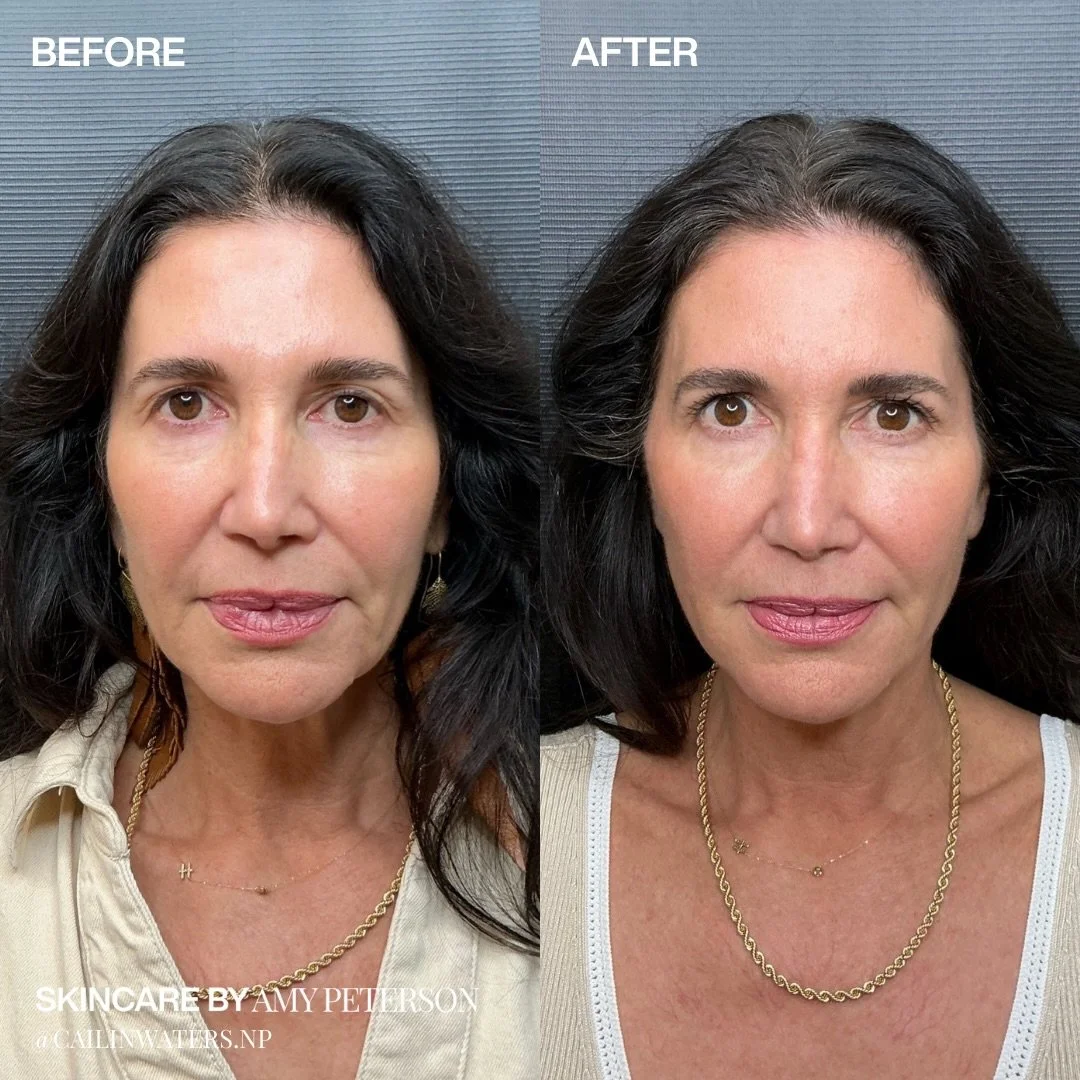 Lifted. Refreshed. After just one treatment.

A subtle pre-auricular Renuva placement can help restore natural support, softly refreshing the face without changing how you look.

Comment &ldquo;LIFT&rdquo; to learn more.