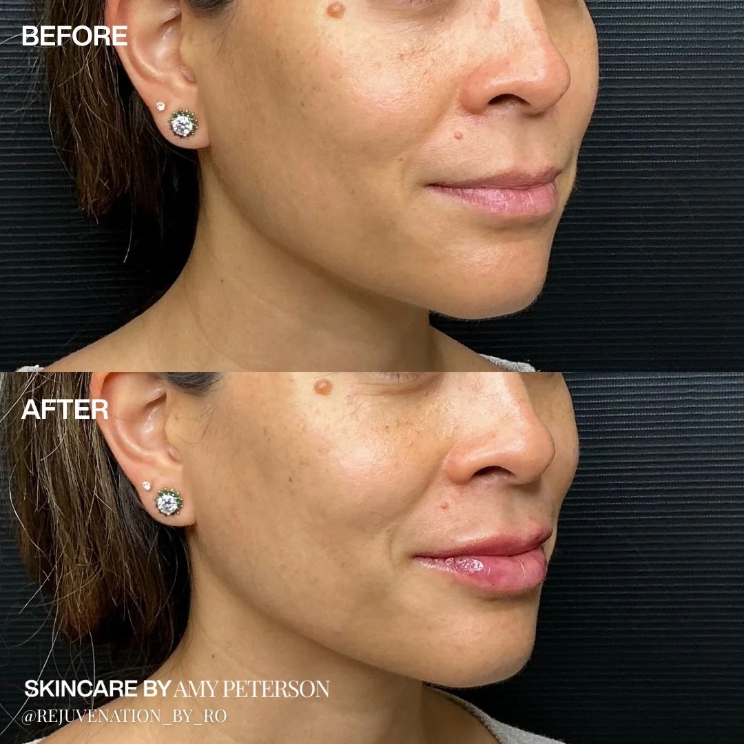 The best results never announce themselves. A subtle lip refresh designed to enhance shape, not change it.

Book your consultation to learn what&rsquo;s right for your lips. 💋 Link in bio.