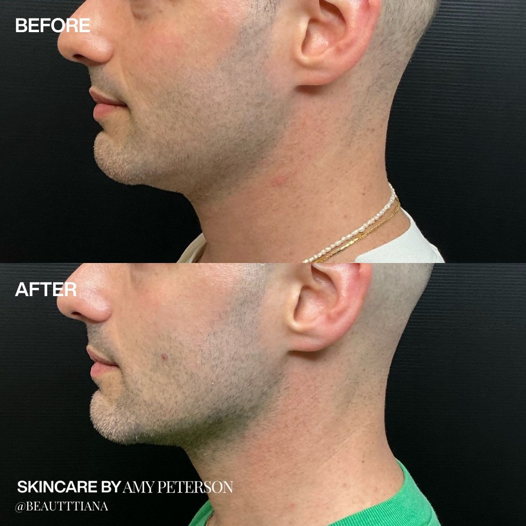 A more refined, defined jawline without adding filler.

This result was created with 0% filler and 100% architectural work. Just thoughtful treatment planning to support structure, improve definition, and bring everything into better balance.

Every 