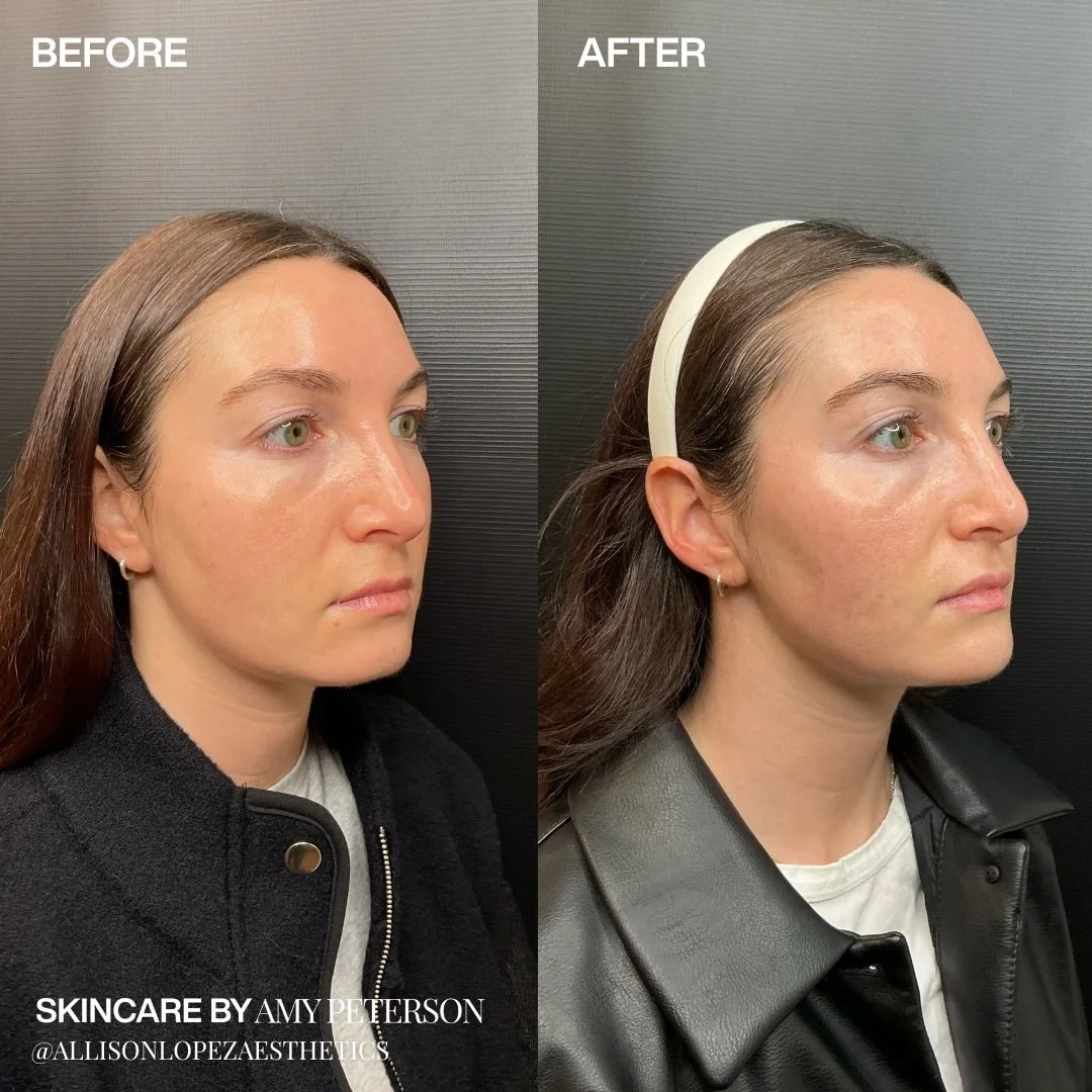 Filler has its time and place. When it&rsquo;s done thoughtfully and in the right hands, it can be a really beautiful tool. 

The most important part is knowing when to use it, where to place it, and when to hold back.

This before + after is a great