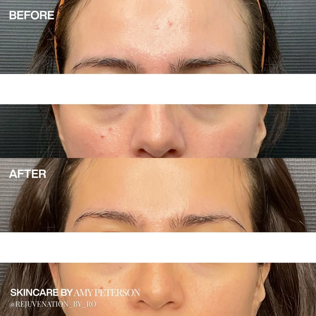 This undereye before &amp; after shows what the right treatment can do when it&rsquo;s chosen for your skin and anatomy.

No two undereyes are the same, which is why results should never be cookie-cutter.

DM us or click the link in our bio to set up