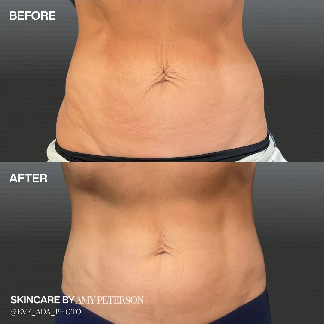 One of our favorite combos for the abdomen 🤍
Emsculpt + BodyEStiq

Emsculpt strengthens and builds the muscle.
BodyEStiq tightens and firms the skin.

Together, they create a smoother, more toned look through the midsection.

Click the link in our b