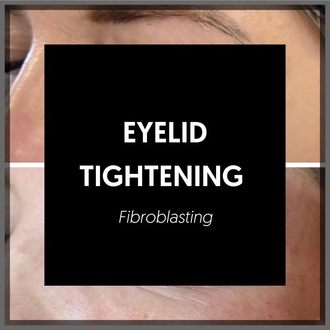 Eyelid Tightening
&pound;150
These results are after a single session, 12 weeks apart.