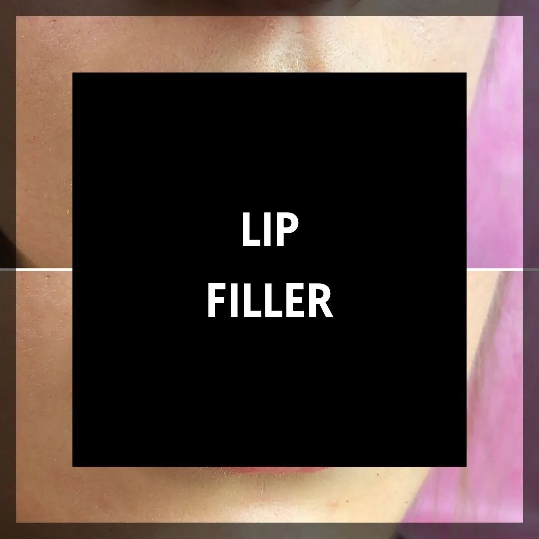 Lip Filler
Beautifully and subtly enhanced lips that still look natural
.
.
.
#lips #lipflip #lipfillerbeforeandafter #lipfiller #makeuplooks