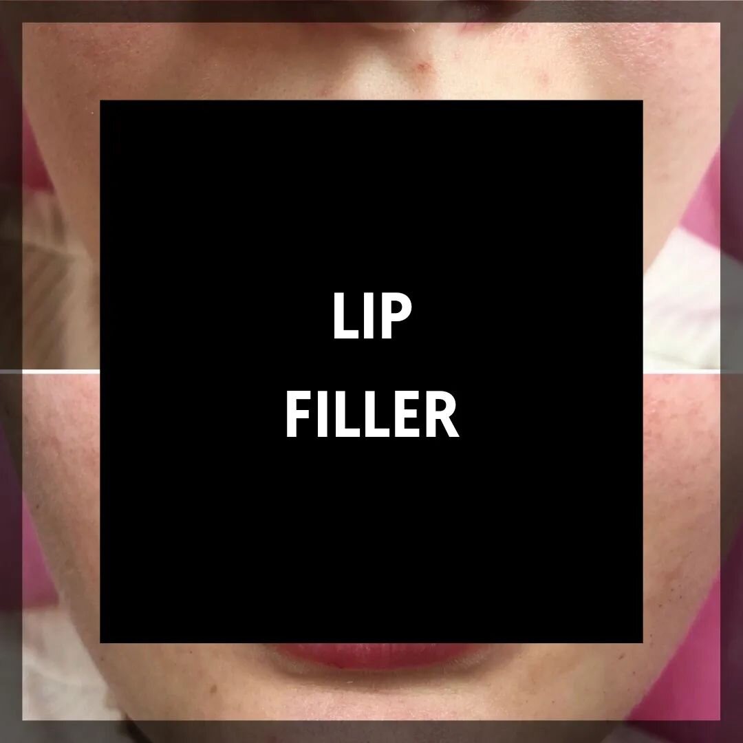 Luscious bouncy lips
.
.
.
#lips #lipfiller #lipfillerbeforeandafter #lipsfordays #perfectlips #fulllips #healthylips