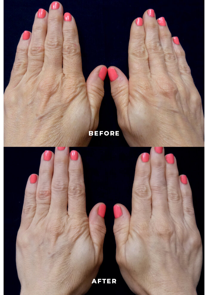 BTL Exilis Ultra 360_before and afters6.jpg