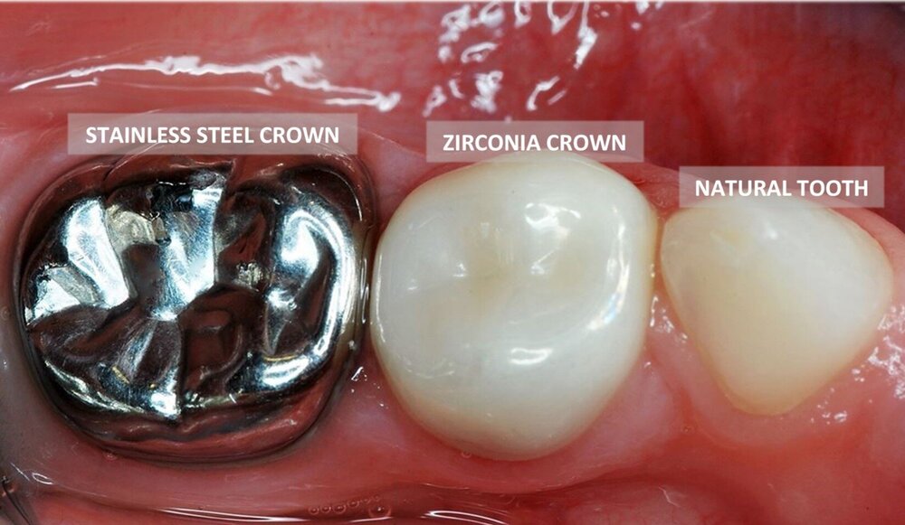 Tooth coloured (zirconia) crowns — Children's Dental Specialist Sydney - Dr Udit Bhatnagar