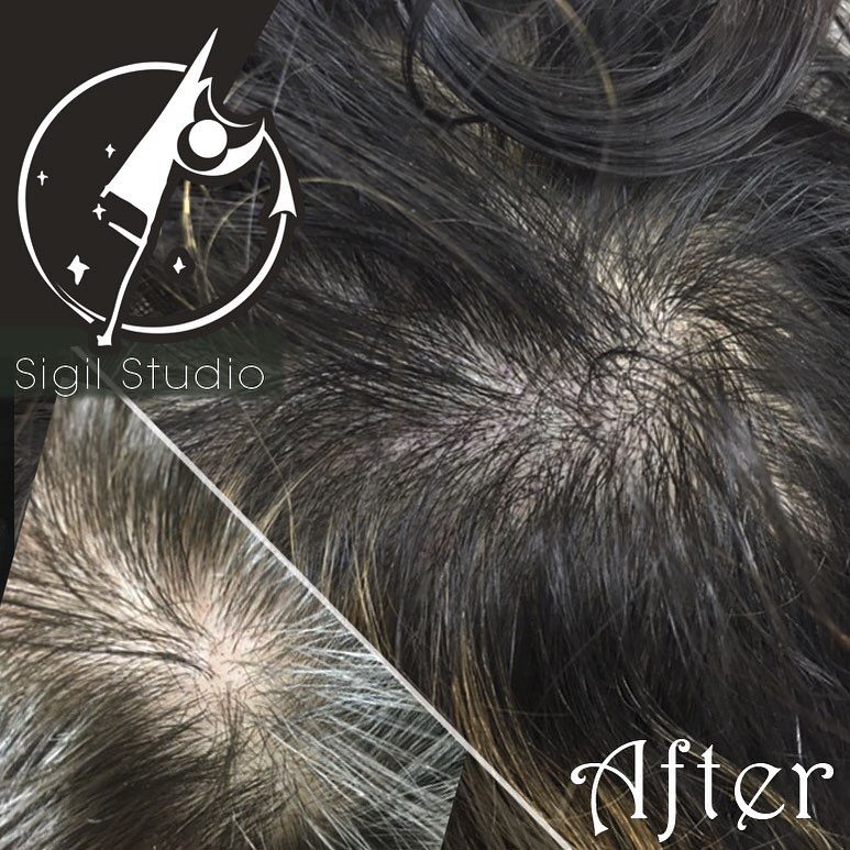 -
Struggling with thin hair?
We&rsquo;re here to help.

Feel like the person you are instead of the situation you&rsquo;re in. Results of third session Scalp Micropigmentation to add density. Booking now for NC and NYC.

* Fast
* Lasting results
* Na