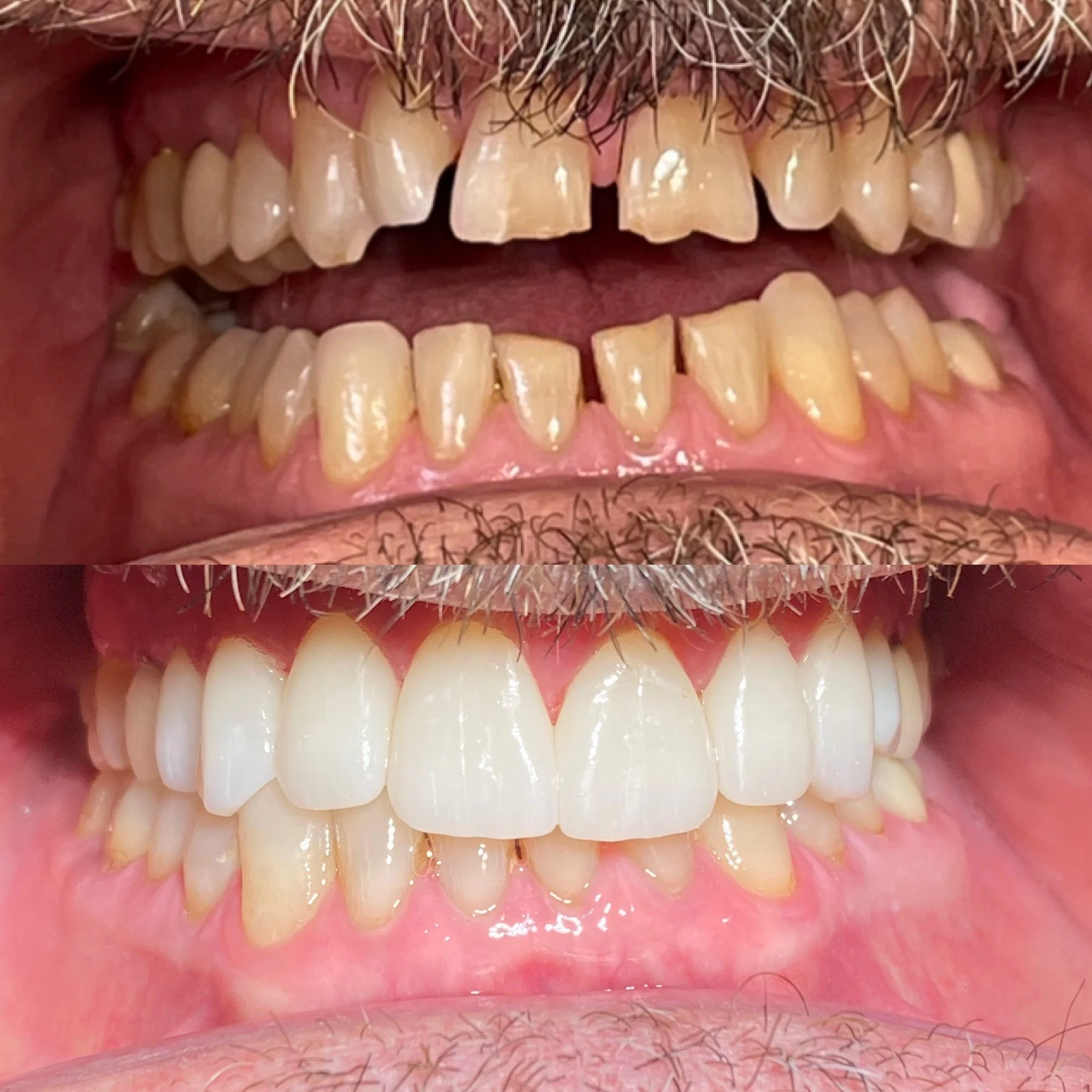 veneers-2.JPG