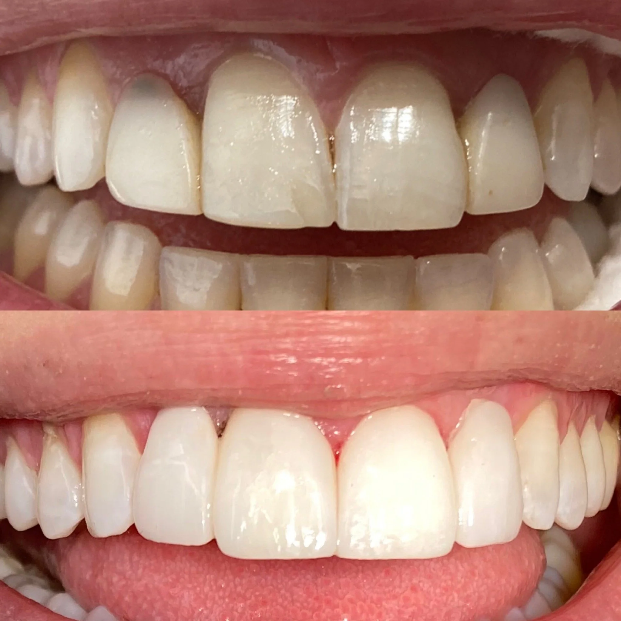 veneers-1.JPG