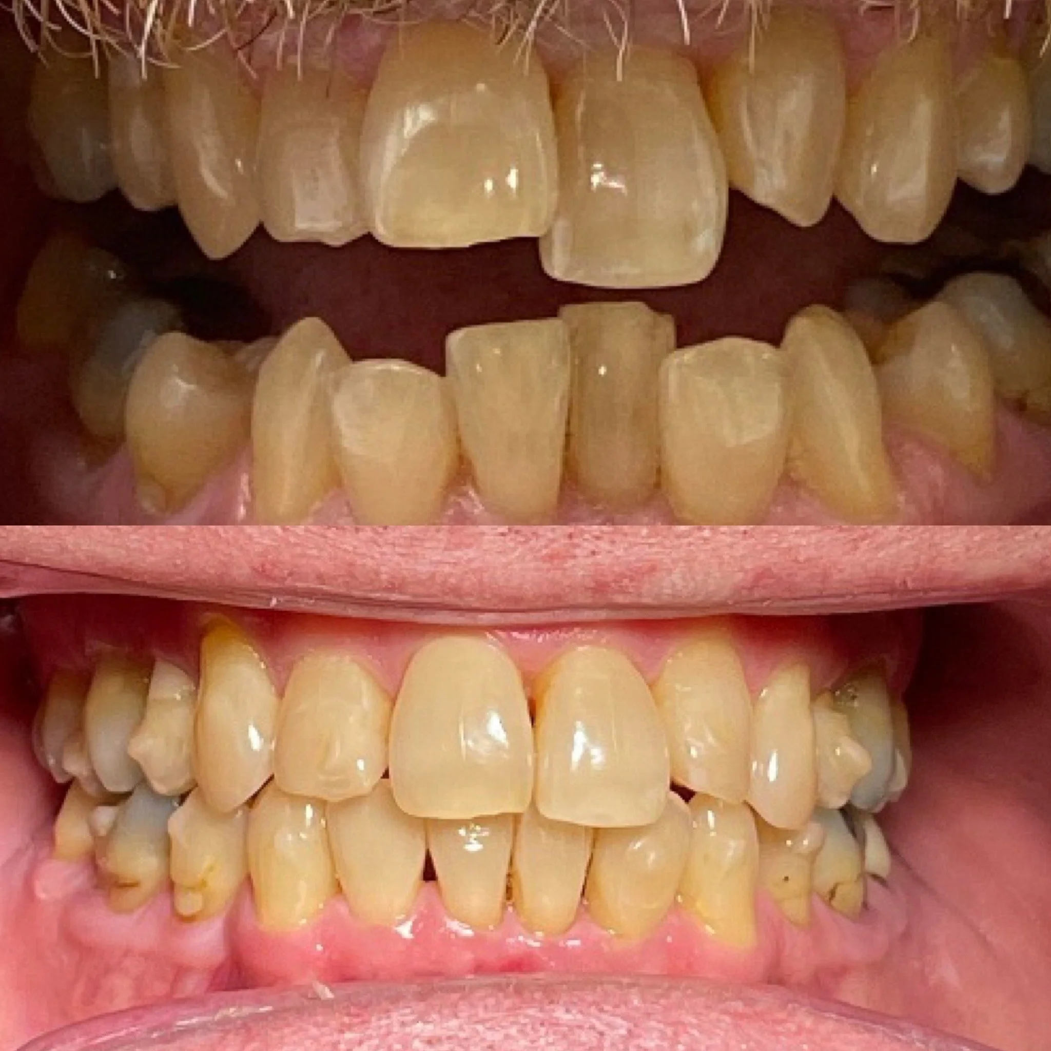Invisalign-1.JPG