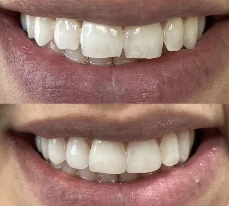 #001 Edges of the teeth were smoothed and the composite bonding was added to reshape for a smoother, more consistent look.
