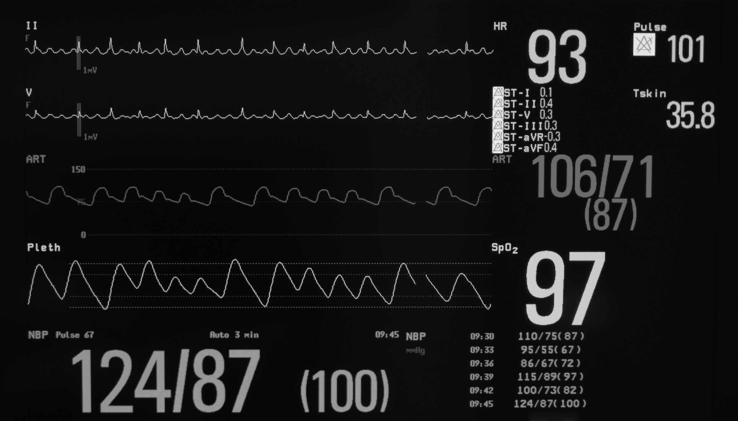 What Can a Holter Monitor Detect?