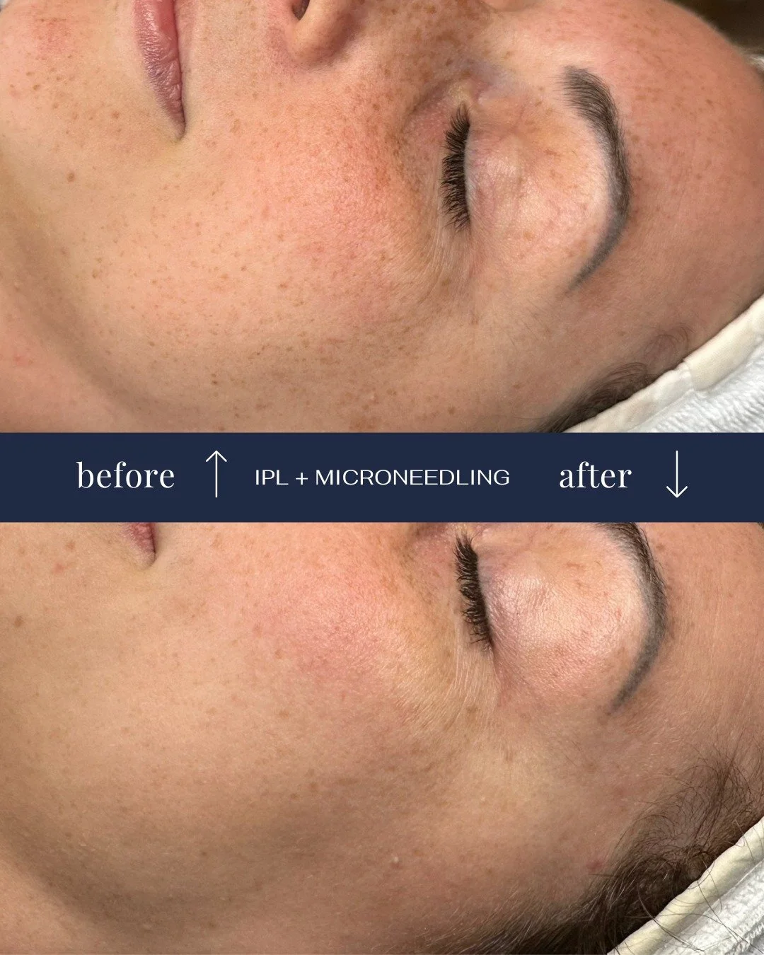 R&eacute;sultats visibles: moins de taches pigmentaires et de rougeurs, un teint plus clair, raffin&eacute; et lisse. Voil&agrave; ce que l&rsquo;IPL et le microneedling peuvent faire pour votre peau.

R&eacute;servez votre rendez-vous en ligne d&egr