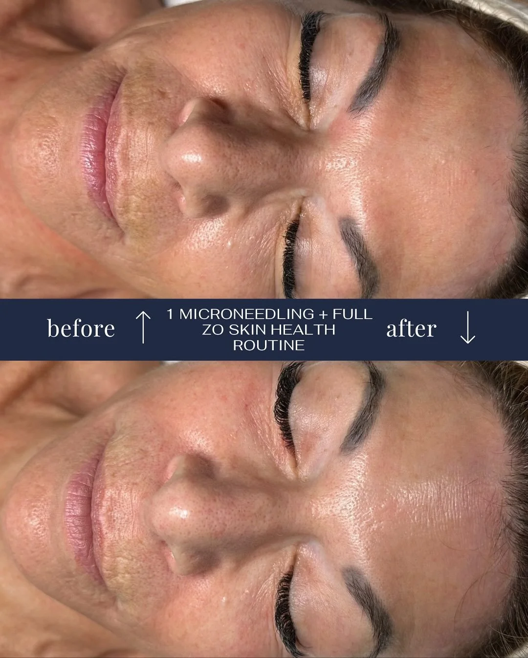 Voici la preuve que 80% &agrave; la maison + 20% en clinique = des r&eacute;sultats incroyables. ✨

Cela ne fait que 4 semaines, et il lui reste encore 5 mois &agrave; parcourir pour terminer son traitement.

Prenez rendez-vous avec nous d&egrave;s a