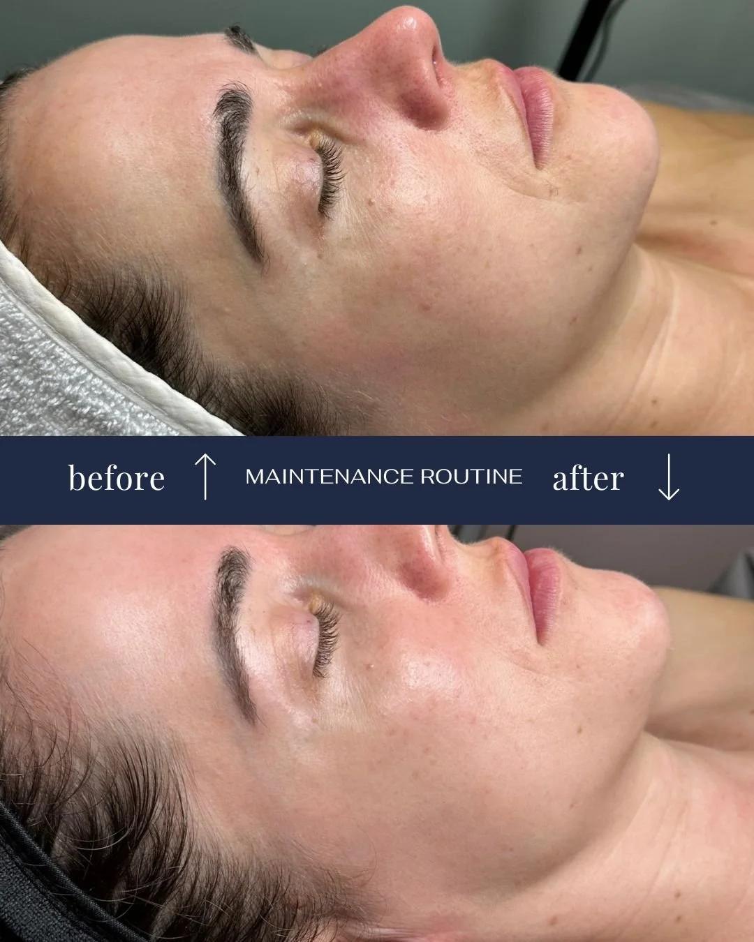 Clea mise sur la constance&hellip; et &ccedil;a para&icirc;t 👀

En entretien, elle alterne microneedling, peelings et IPL toutes les 8 &agrave; 12 semaines pour garder une peau saine et lumineuse.

&Agrave; la maison, sa routine est tout aussi strat