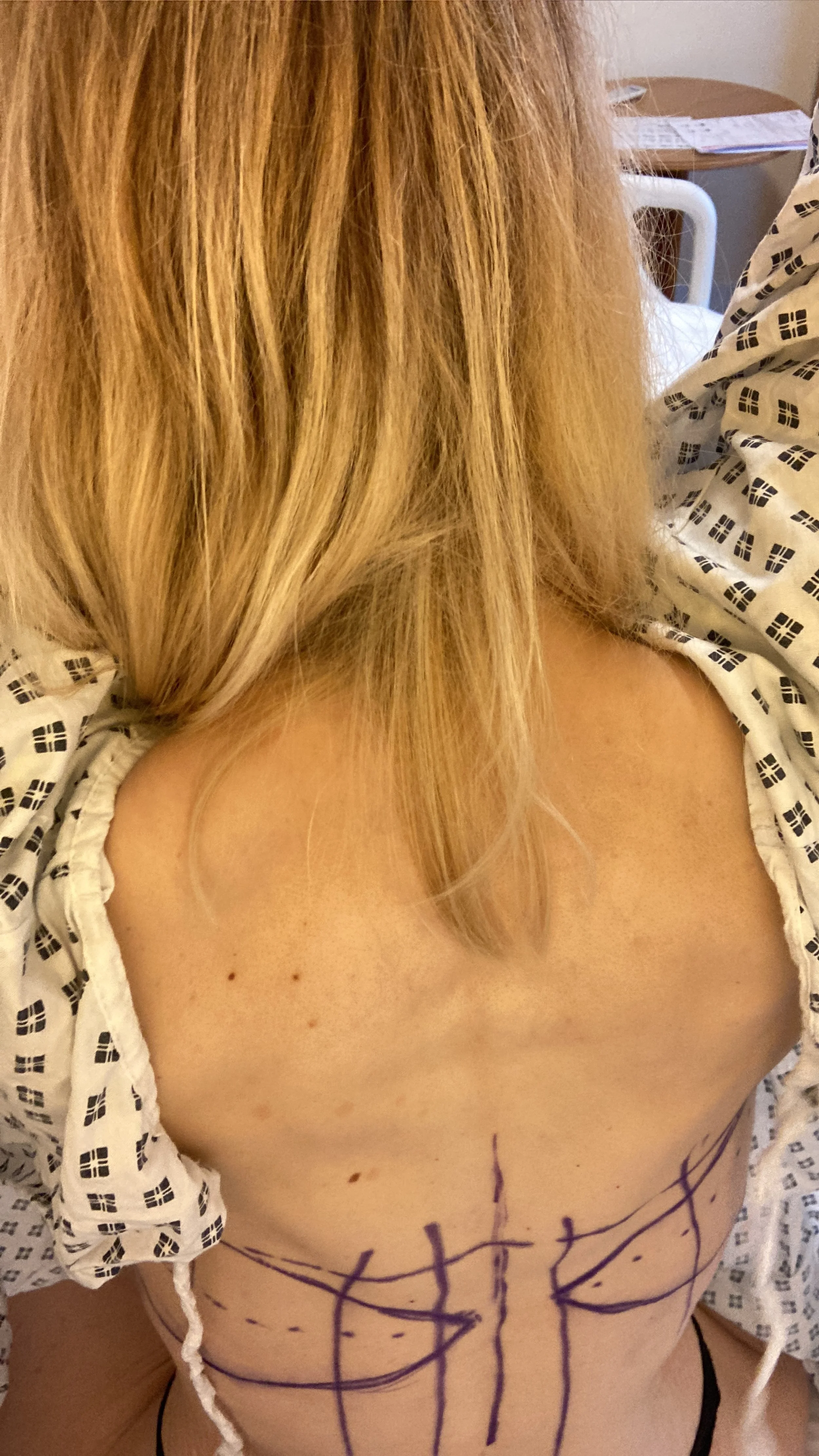 One of the loose skin removal surgeries I had after my extreme weight loss.