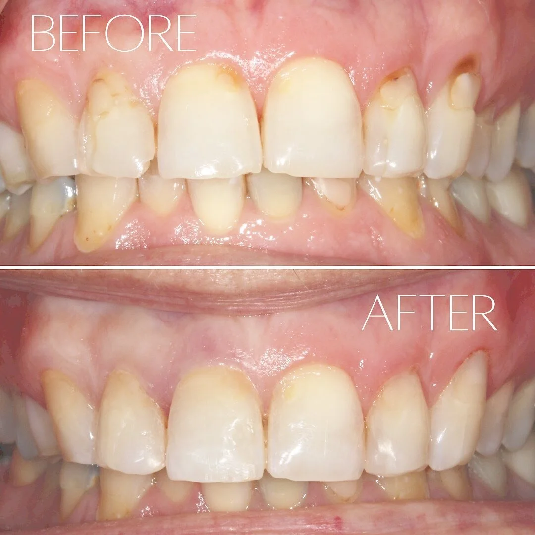 Sometimes a little bonding touch-up is all you need to start smiling bigger 😀 . . .  #bartlettdentist #dentistmom #dentist #familydentist #chicagodentist