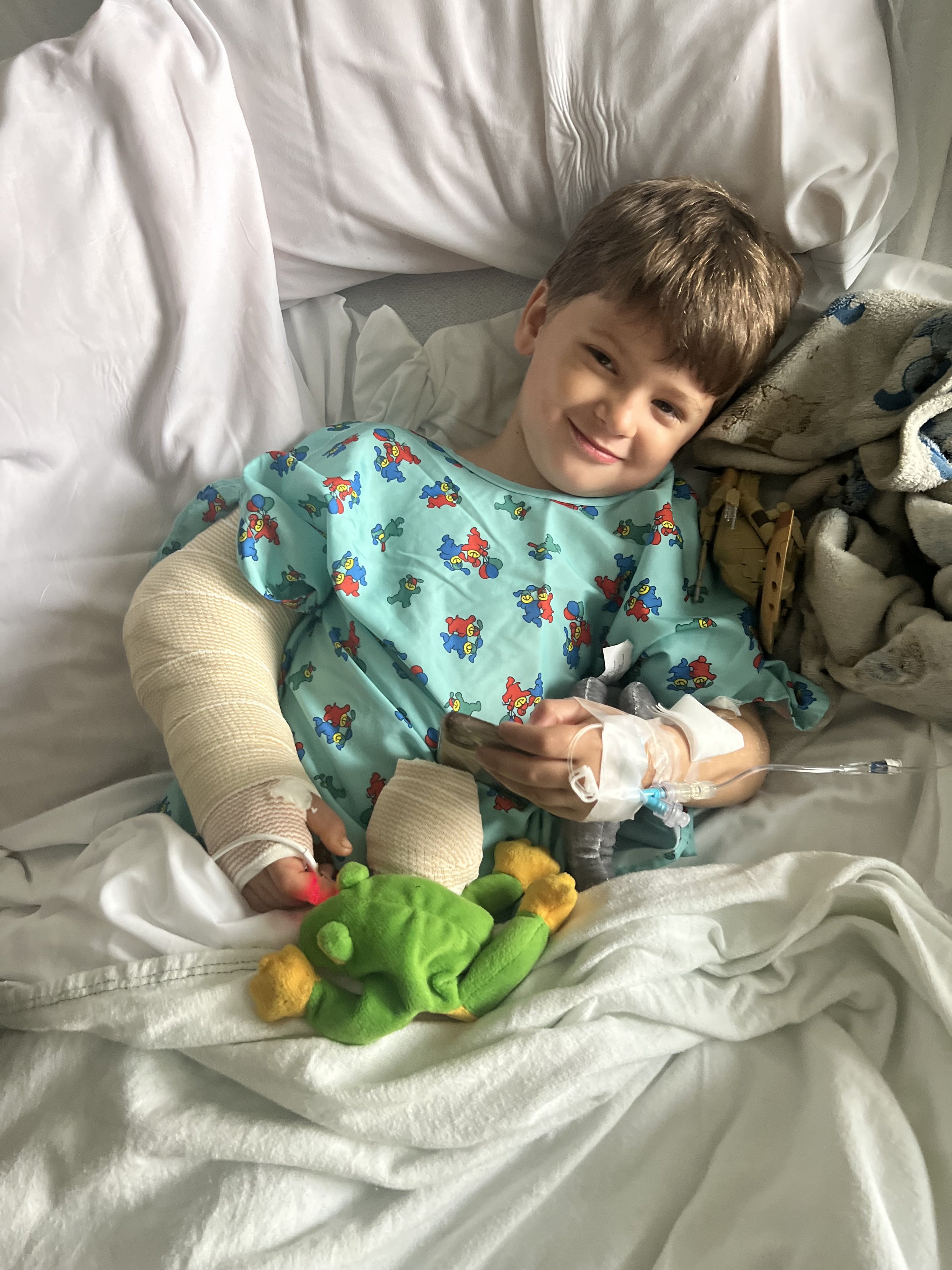 Our son broke his arm.