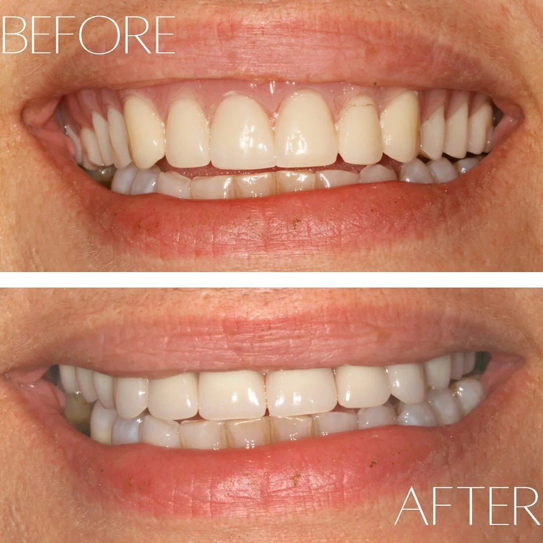 After giving one of our kindest patients back the comfort of smiling naturally again, we couldn&rsquo;t help but share the results! Her old pair of dentures were bulky, uncomfortable, and didn&rsquo;t allow her to close her lips. We love taking the t