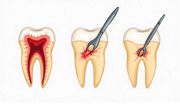 Do I Need a Root Canal or an Extraction? How Dentists Decide the Best Option