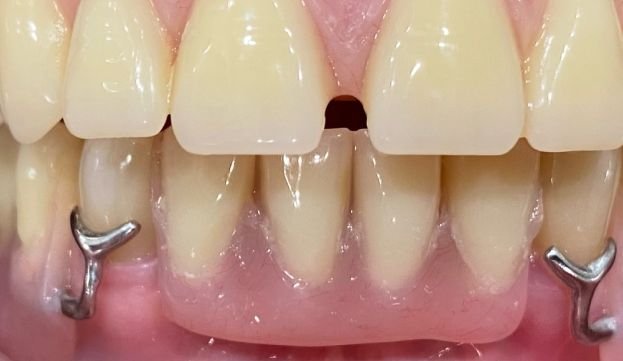 What Are Dentures and How Do They Work?