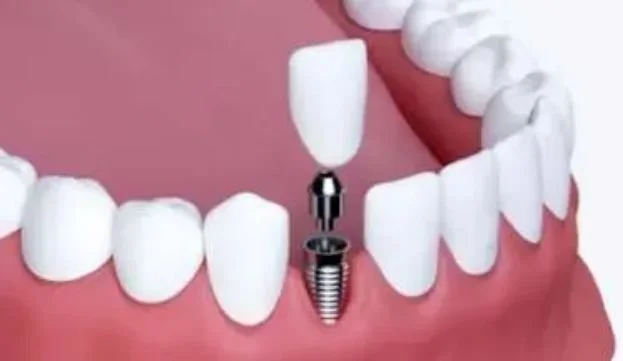 Signs You May Need Dentures Instead of Dental Implants