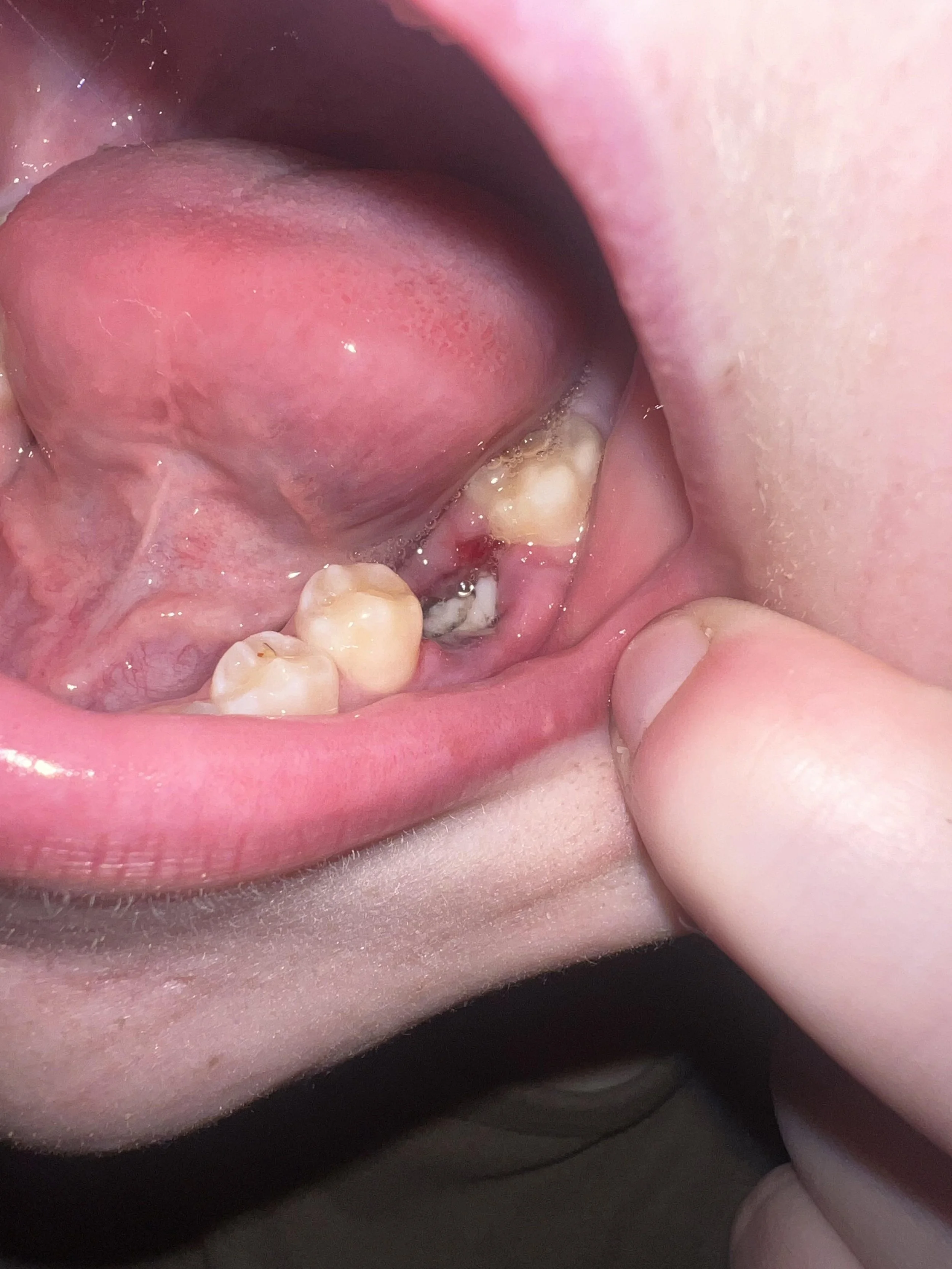 What Does an Infected Tooth Extraction Look Like?