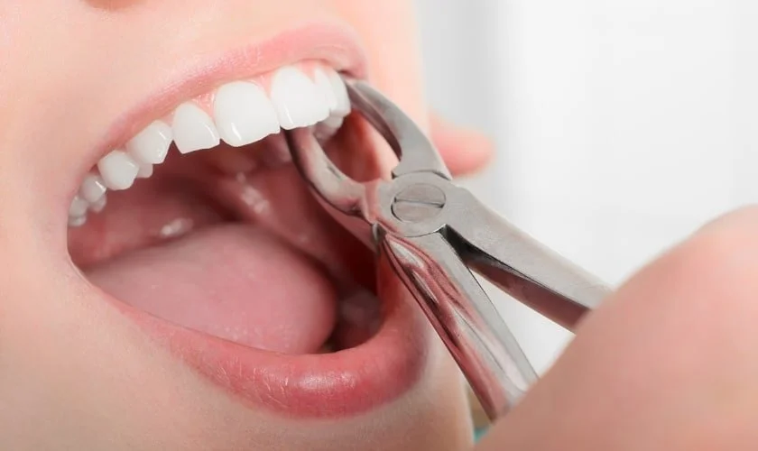 How Long Do Gums Take to Heal after Tooth Extraction?