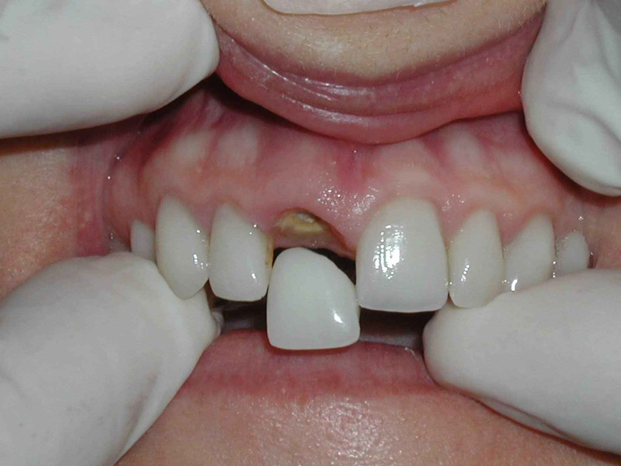 Front Teeth Flipper Tooth after Extraction