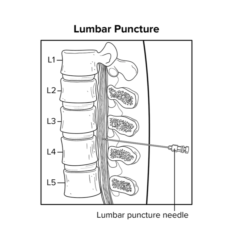 Lumbar Puncture