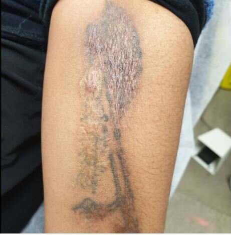 Tattoo removal creams vs laser tattoo removal — Skin Deep, Wellington