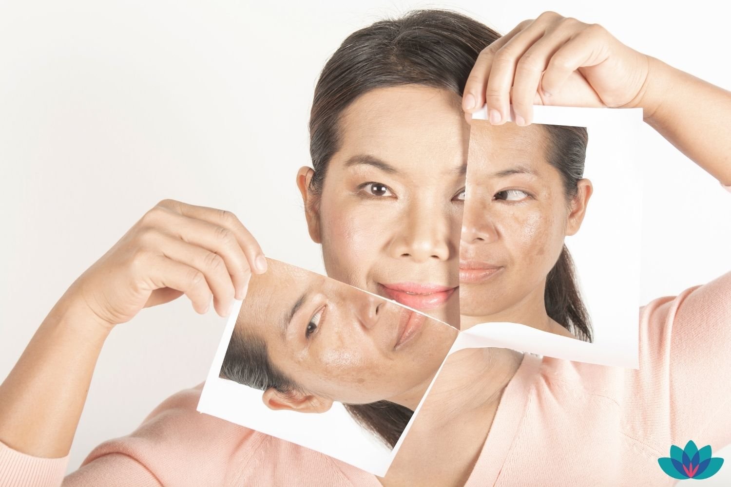 The 21 Most Effective Treatments for Melasma [Infographic]