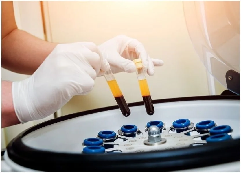 A person holding a tub of blood in each hand. The person has just taken the tubs of blood out of a centrifuge. The tubes of blood have been spun so that the platelet rich plasma has been separated from the red blood cells.