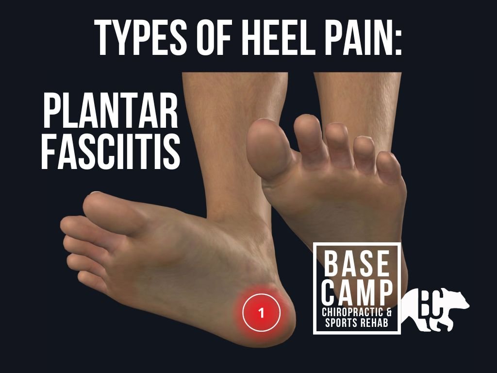 What Causes Plantar Fasciitis In Basketball Players?