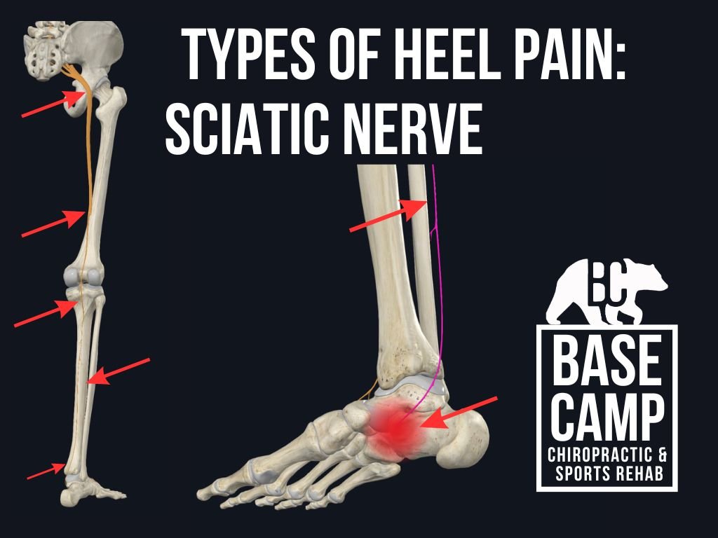 Heel Pain in Runners — Base Camp Chiropractic & Sports Rehab