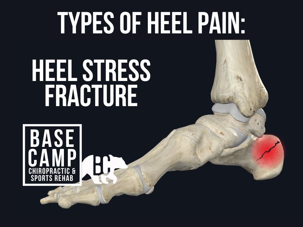 Broken Heel Bone - Calcaneus Fracture — Bone Talks