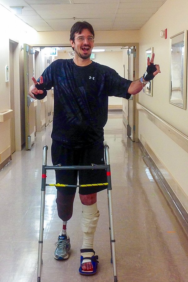 Damian learning to walk with a prosthetic.jpg