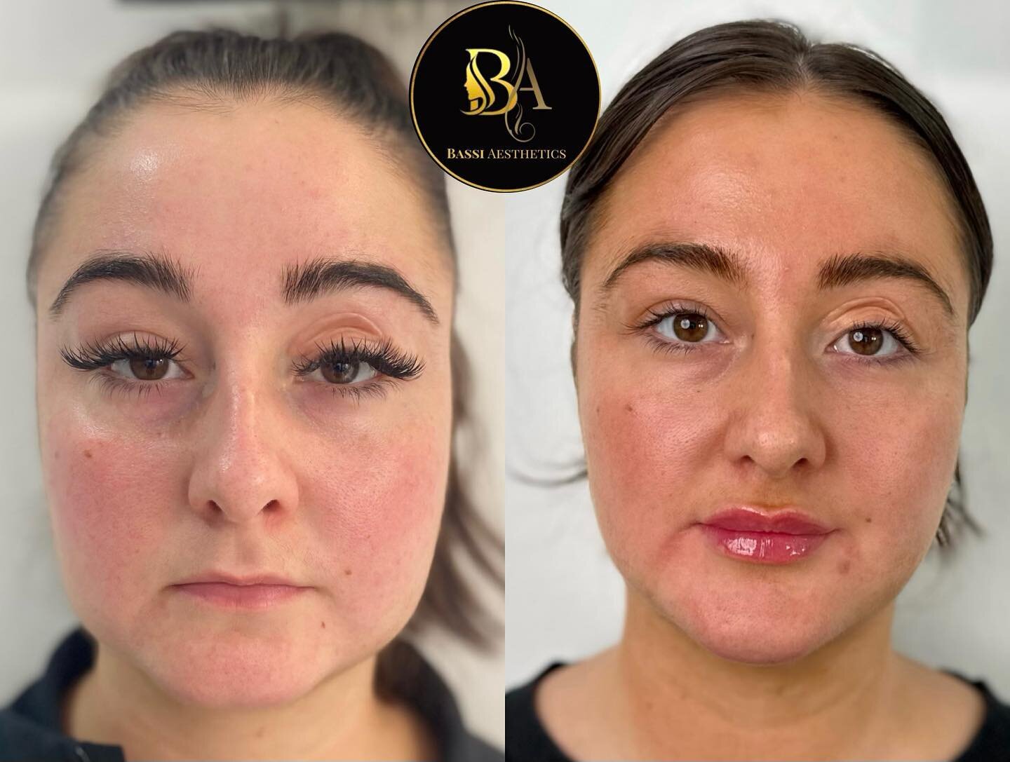 The areas we treated for our lovely patient are: 

🌟Masseter Anti-wrinkle to debulk the jaw area and slim down the face 
🌟Lip filler to volumize &amp; add fullness to the lips
🌟Chin filler to add length to the chin which slims down face, and to na