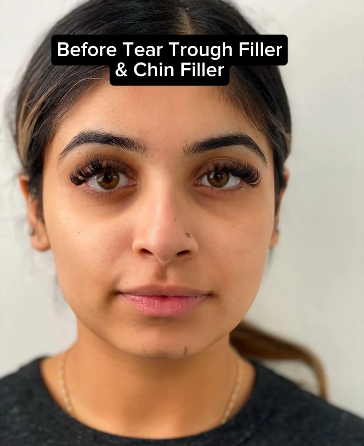Did you know dermal fillers can do more than just add volume?
Tear trough filler works to soften under eye hollows, reducing shadows that make you look tired. The result? A fresher, brighter, and more rejuvenated appearance without makeup.
Chin fil