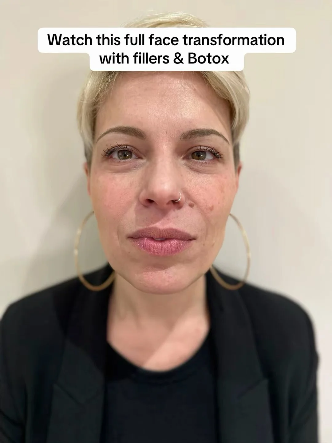 Here we have got rid of our clients forehead wrinkles, frown lines & crows feet. 
We also helped her tired under eyes with tear trough filler. We also added filler in the mid cheek area to help plump up her cheeks. 
Lastly we narrowed her chin
