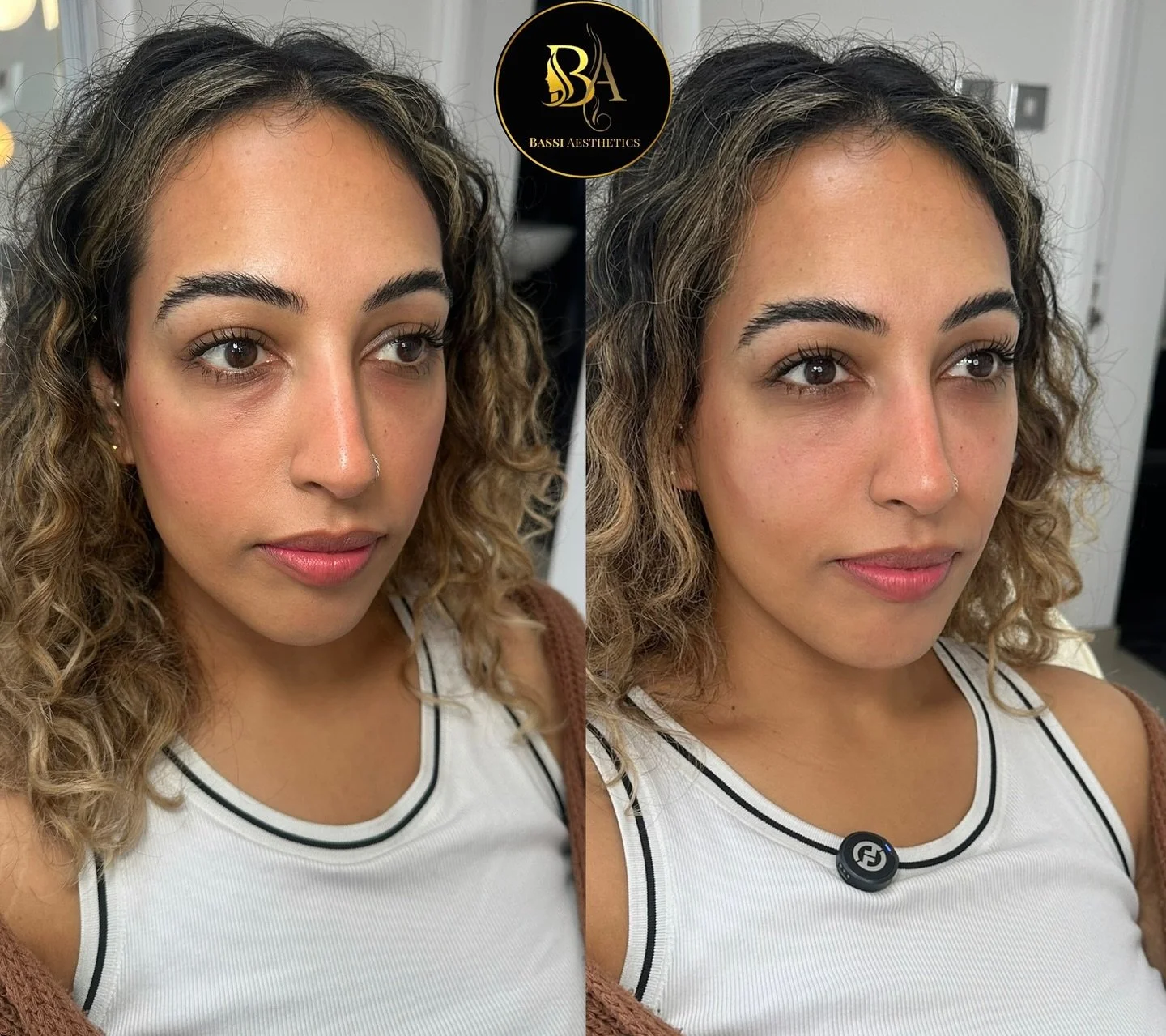 Thinking about tear trough filler? Here are 4 things you need to know: 
1️⃣ You need hollow under eyes — this means volume loss, not puffiness.
2️⃣ Your skin quality should be good enough to hold the filler smoothly.
3️⃣ You should not have pu