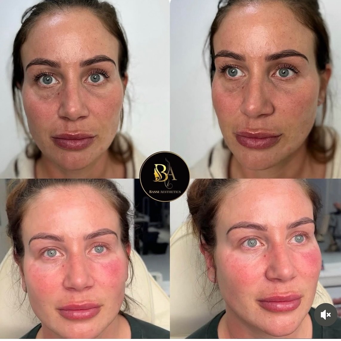 Here we have addressed our clients under eye area with a combination of fillers &amp; polynucleotide. 

Benefits of polynucleotide: 

-Skin revitalisation to combat general signs of ageing
-Improves Acne Scarring
-Rehydration for dull skin
- Improves