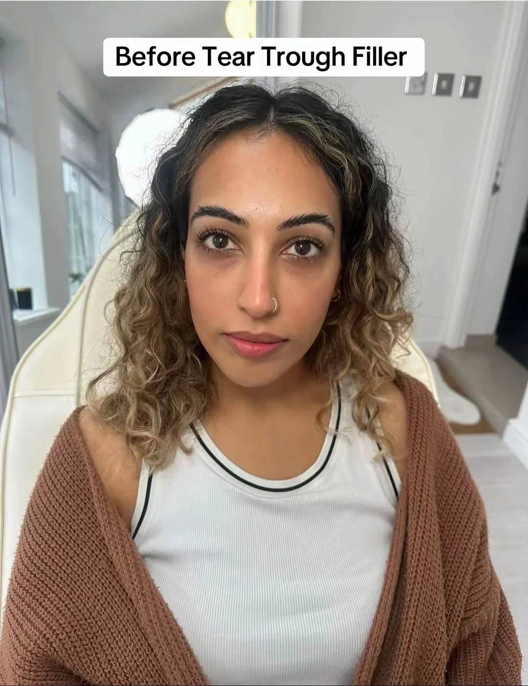 Thinking about tear trough filler? Here are 4 things you need to know: 

1️⃣ You need hollow under eyes &mdash; this means volume loss, not puffiness.
2️⃣ Your skin quality should be good enough to hold the filler smoothly.
3️⃣ You should not have pu