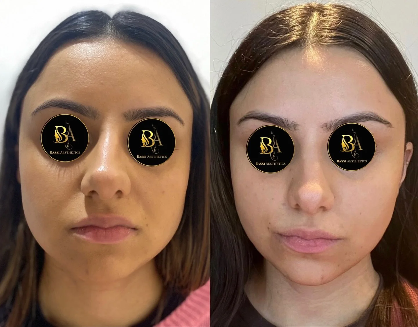 Have you heard about masseter slimming? It&rsquo;s a non-surgical cosmetic treatment that can help you achieve a more symmetrical and slender facial shape. Here are some of the benefits:

✔️ Slimmer face: Masseter slimming targets the masseter muscle