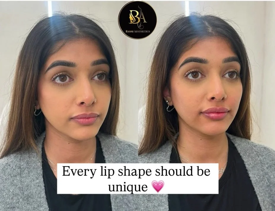 No two lips are the same so why should the results be?

When we work with your natural lip shape and respect your anatomy, we create soft, subtle, and beautifully individual results that enhance what you already have. 

Benefits of lip fillers:
👄 Ad