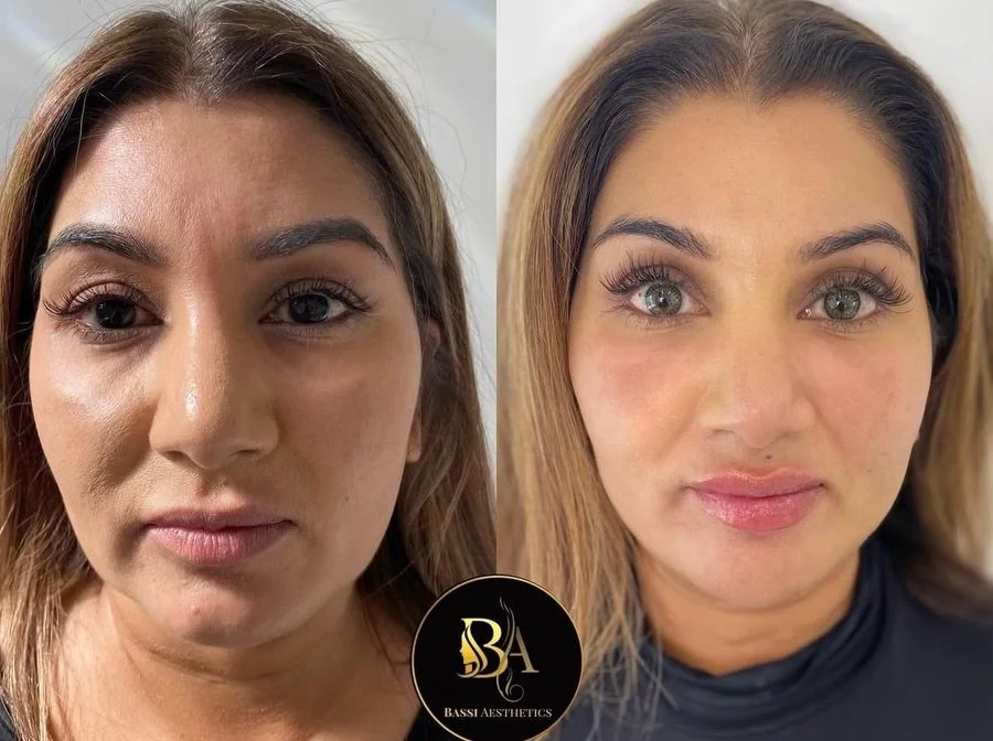 Chin filler plays a key role in facial proportion and profile balance.

By adding vertical length, we can help create the appearance of a slimmer lower face.

By refining and narrowing the chin, we can feminise facial contours.

From the side profile